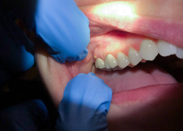 Best Emergency Gum Pain Relief  in Miamitown, OH