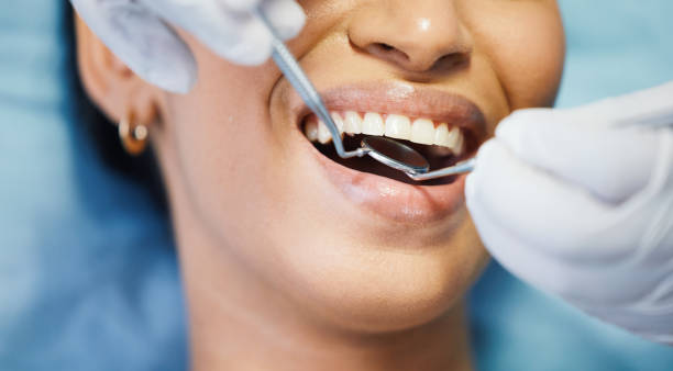 Emergency Dental Filling Replacement in OH